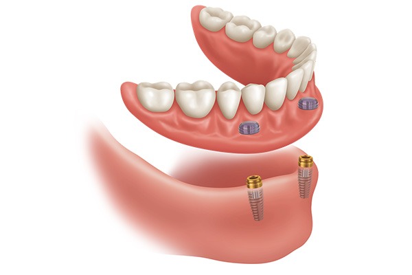 Implant Supported Dentures | Key Prosthodontist | Prosthodontic Specialist SW Calgary