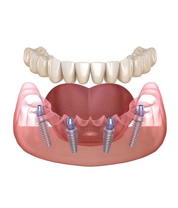 Benefits of an all on 4 Dental Implant | Key Prosthodontics | SW Calgary AB