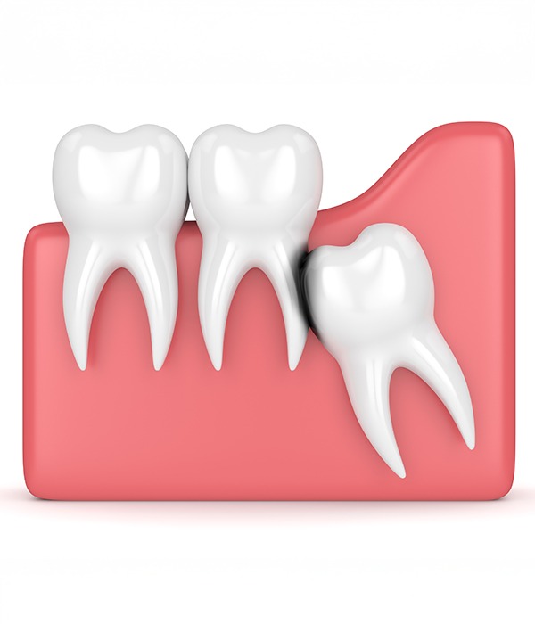More Invasive Full Mouth Reconstruction Could Include | Key Prosthodontics | SW Calgary AB