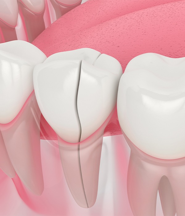 What Are Some Problems Full Mouth-Reconstruction Can Fix | Key Prosthodontics | Calgary AB