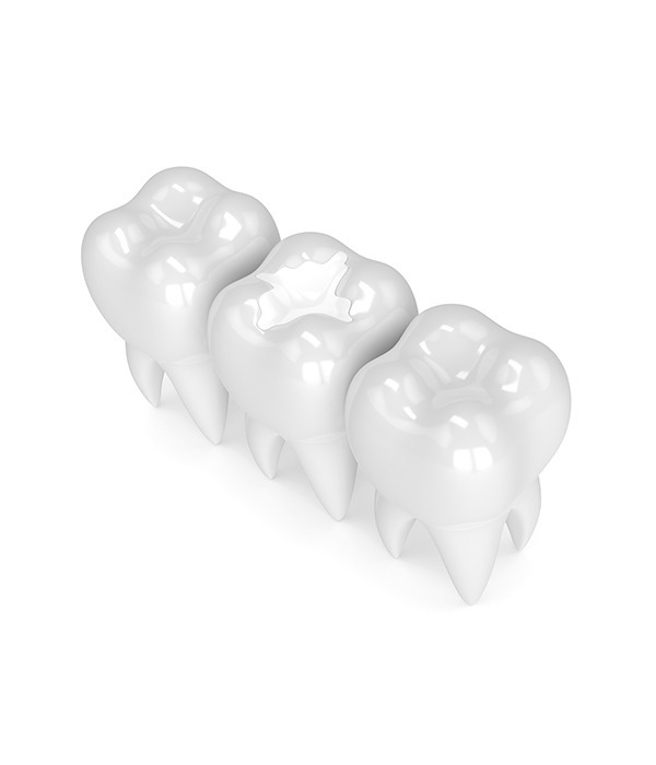What Are The Benefits of Inlays and Onlays | Key Prosthodontics | Prosthodontics Specialist Calgary