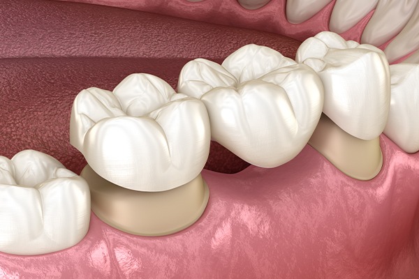 What is a Dental Bridge ? | Key Prosthodontics Prosthodontic Specialist | SW Calgary