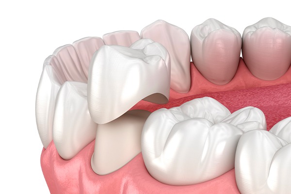 What is a Dental Crown? | Key Prosthodontics | Prosthodontics Specialist | SW Calgary AB