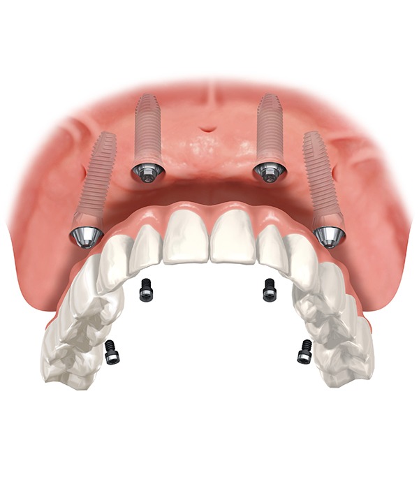 What is an all on 4 Dental Implant | Key Prosthodontics | SW Calgary AB