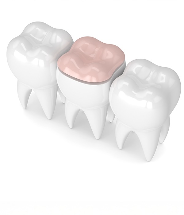 Inlay and Onlay in Dentistry | Key Prosthodontics | SW Calgary AB