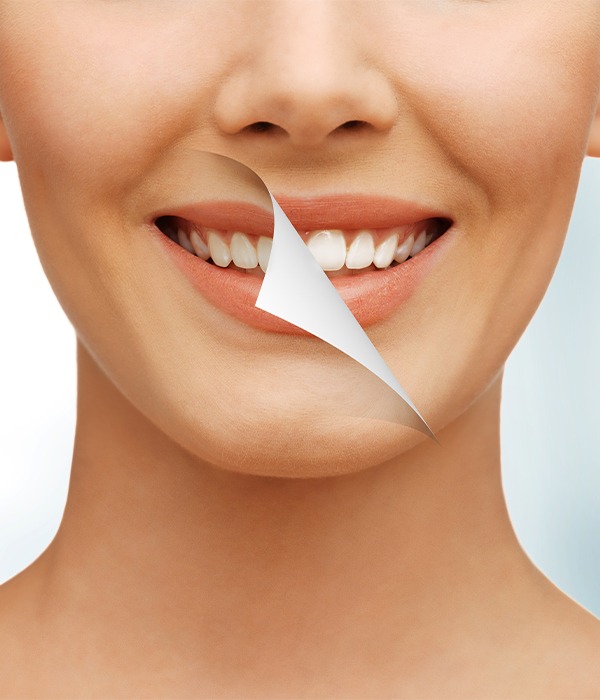 Teeth Whitening | Key Prosthodontics | Prosthodontics Specialist SW Calgary
