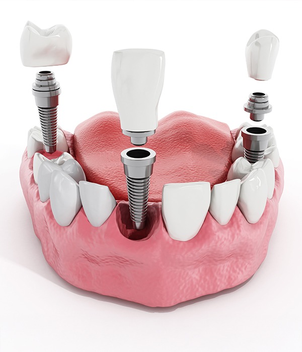 What Services Are Included in a Full Mouth Reconstruction | Key Prosthodontics | SW Calgary AB