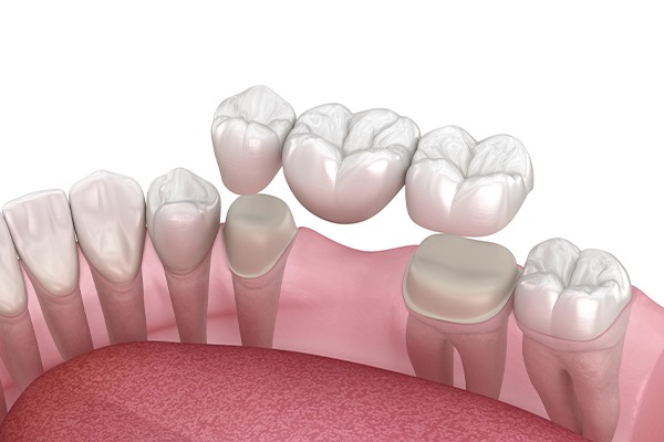 When Are Dental Bridges in SW Calgary | Key Prosthodontics | Calgary AB