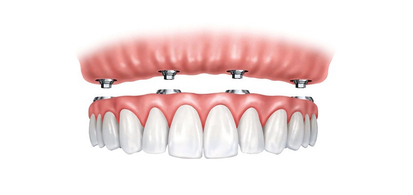 Calgary Dental Implants | Key Prosthodontics | SW Calgary AB