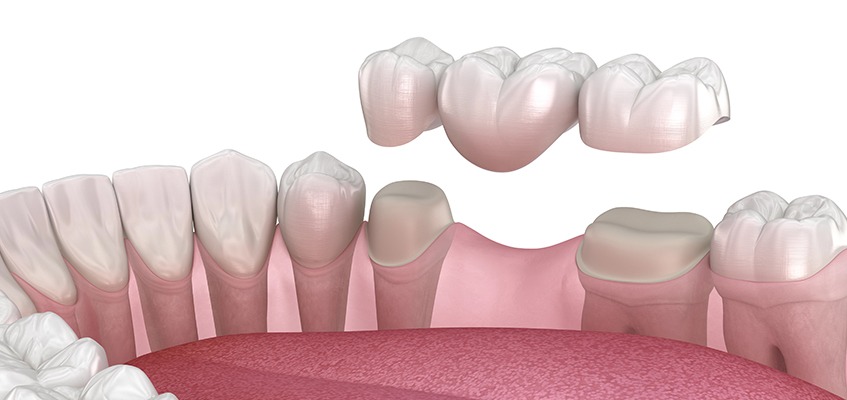SW Calgary Dental Bridges | Key Prosthodontics | Prosthodontic Specialist | Calgary AB