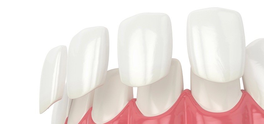 Full Mouth Reconstruction Calgary | Key Prosthodontics | SW Calgary