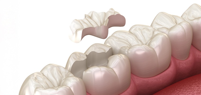 Porcelain Inlays and Onlays | Key Prosthodontics | Prosthodontics Specialist | Calgary AB